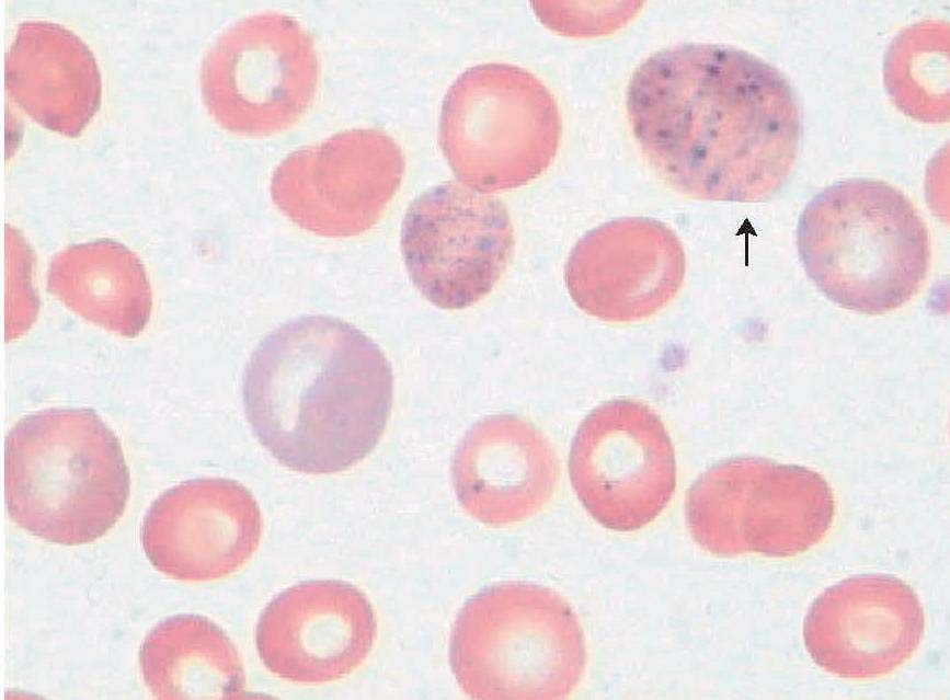 嗜碱性点彩红细胞